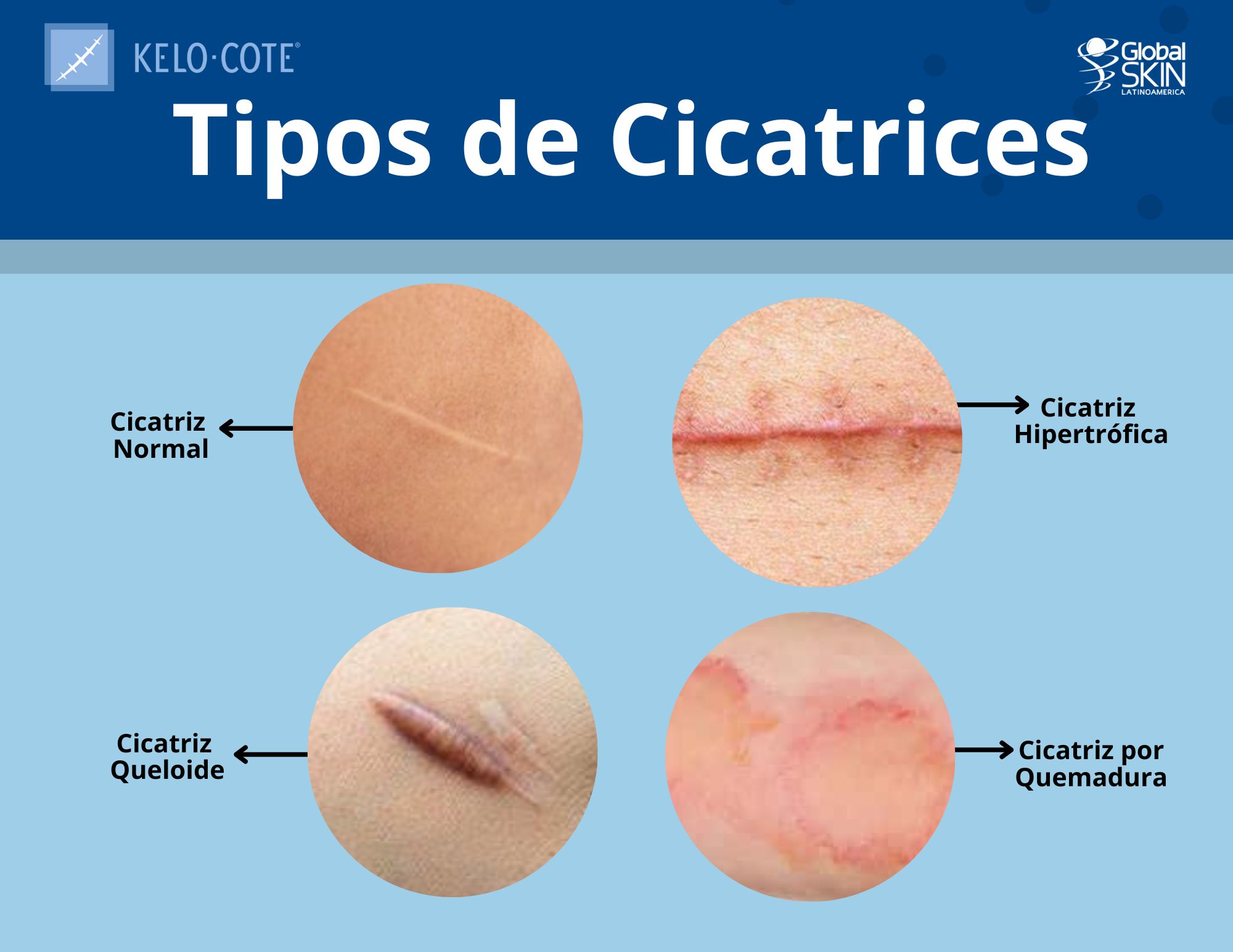 tipos de cicatrices