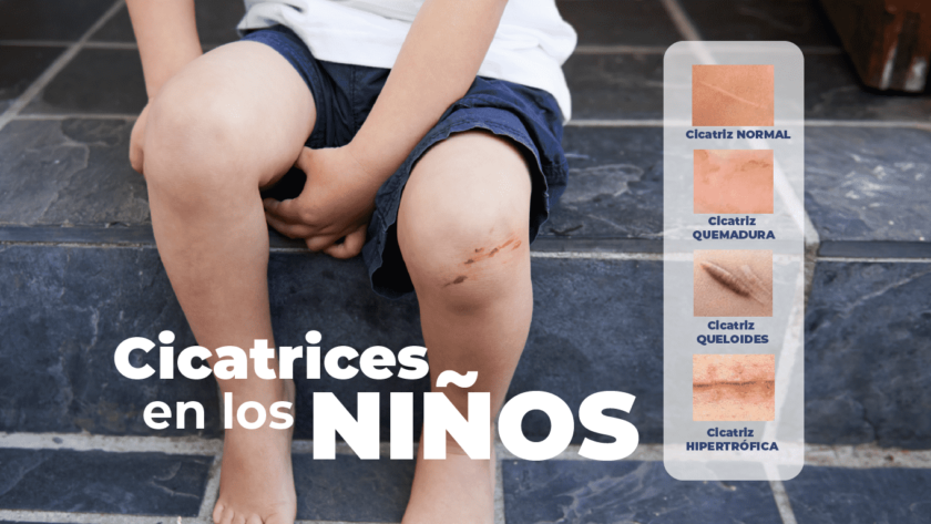 ¿Cómo afectan las cicatrices en los niños y cómo mejorarlas?