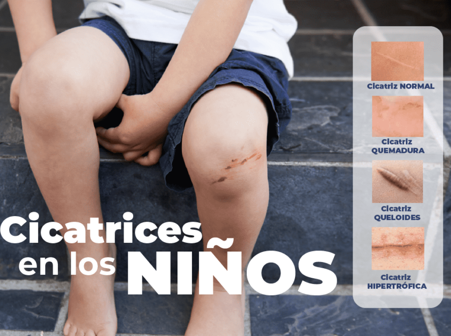 ¿Cómo afectan las cicatrices en los niños y cómo mejorarlas?