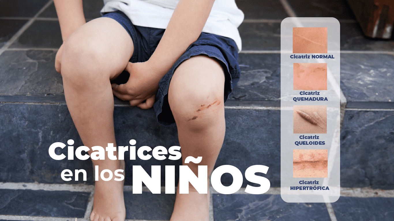 ¿Cómo afectan las cicatrices en los niños y cómo mejorarlas?